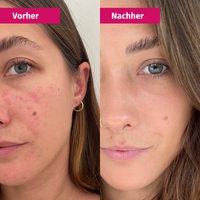 CLARIFYING MASK | Verfeinertes Hautbild dank 2% BHA